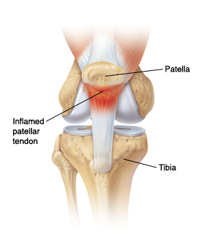 / patellabrace helpt bij jumpers knee / springersknie